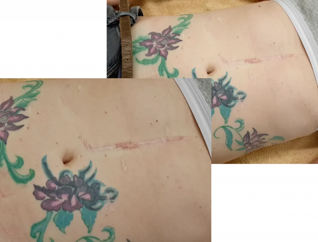 Narbenund deren Bedeutung