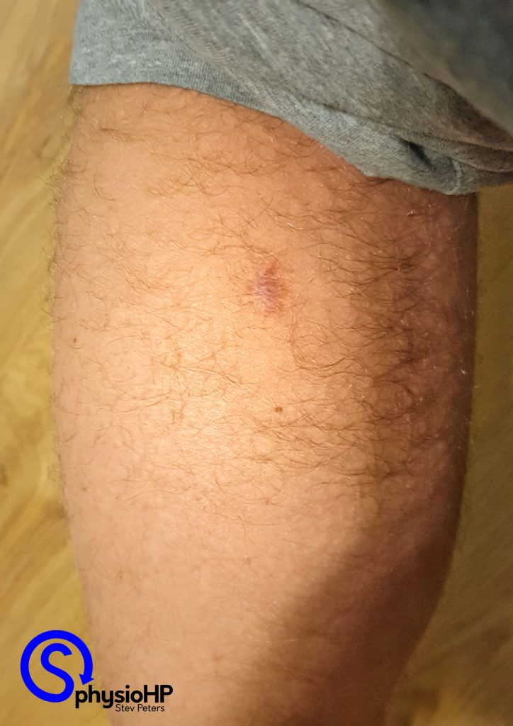 Die Narbe mit der es begann.